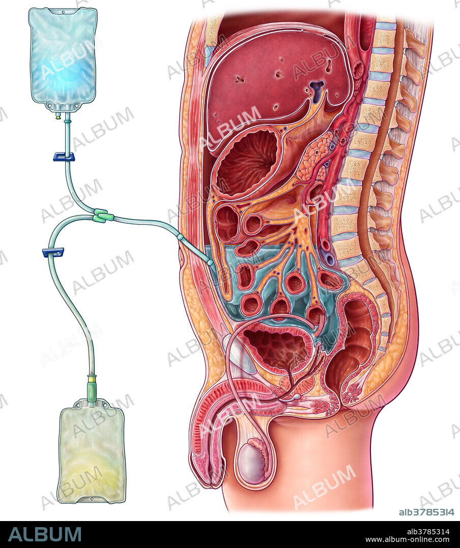 An illustration of peritoneal dialysis, a method used to remove waste from the blood when the kidneys cannot properly function. A catheter is placed into the abdomen and connected to a bag of dialysis solution, known as dialysate. As the solution fills the inside of the abdomen, waste products in the blood diffuse through the peritoneum over the course of four to six hours. The waste fluid is then drained into a separate collection bag and replaced with fresh dialysate. The process is repeated around four to six times a day, keeping two litres of fluid in the abdomen at all times. Peritoneal dialysis is a less common method of filtering blood than haemodialysis, but it allows patients to treat themselves at home or work, and may result in longer lasting residual kidney function and a more stable blood chemistry and hydration level.