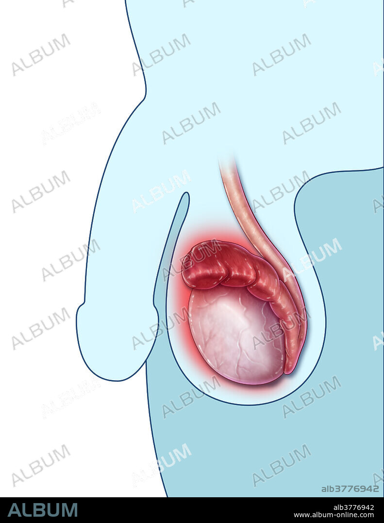 Epididymitis, illustration