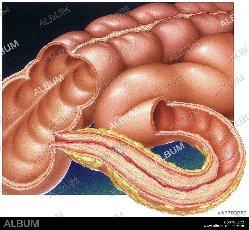 Crohns disease, inflammation of the ileum, the terminal portion of the small intestine, and characterized by abdominal pain and deep ulceration.