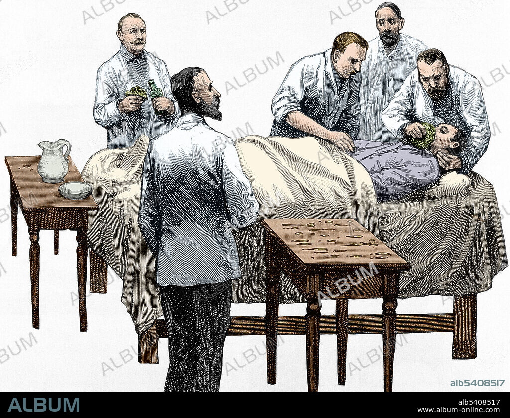 Chloroform anesthesia. Engraving, 19th century. Color enhanced.