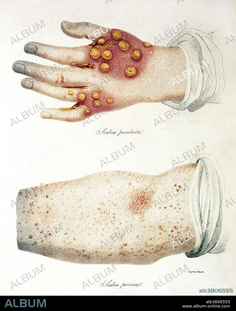 Scabies, Skin Disease, Illustration, 1816
