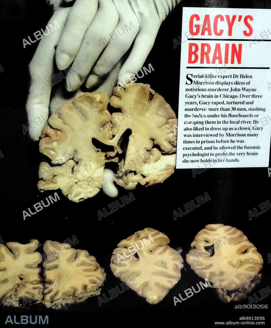 Slices of John Wayne Gacy's brain displayed by Serial Killer expert Dr Helen Morrison. Dr Helen Louise Morrison (1942-) an American forensic psychiatrist and writer. John Wayne Gacy Jr. (1942-1994) an American serial killer and rapist during the 1970s.