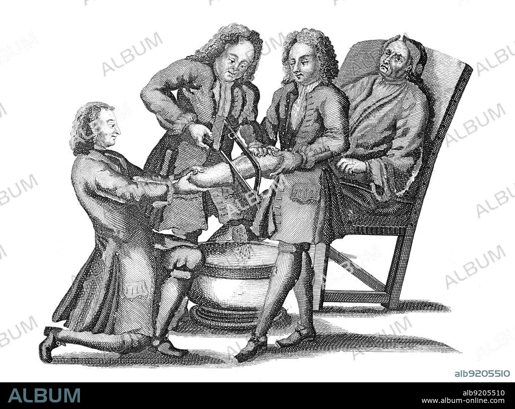 Amputation, Lorenz Heister, 1718. Lorenz Heister (1683-1758) was a German anatomist, surgeon and botanist whose best-known work is Chirurgie, a book on surgery originally published in 1718, from which this 1739 illustration derives. He coined the word "tracheotomy." He is credited with being the first physician to perform a post-mortem section of appendicitis.