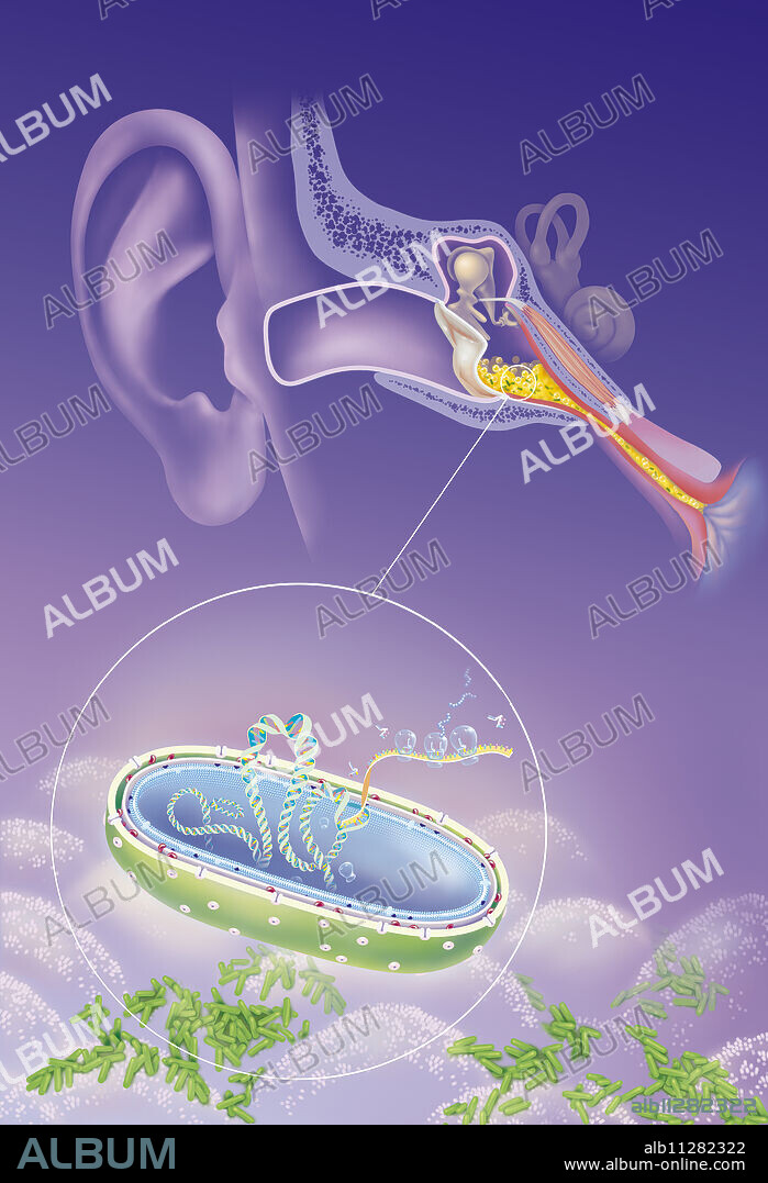 Middle ear with purulent effusion, bulging tympanum, Haemophilus influenzae bacteria. Otitis media acute. Frontal cut of the auditory apparatus passing through the outer ear and the middle ear, bulging tympanum with a purulent effusion in the middle ear and inflammation of the mucosa. Below, zoom in on the mucosa with a Haemophilus influenzae bacteria seen in section allowing to see the different layers of the wall with the betalactamases of the periplasmic space and the PBPs of the cytoplasmic membrane bacterial DNA with the ribosomes.