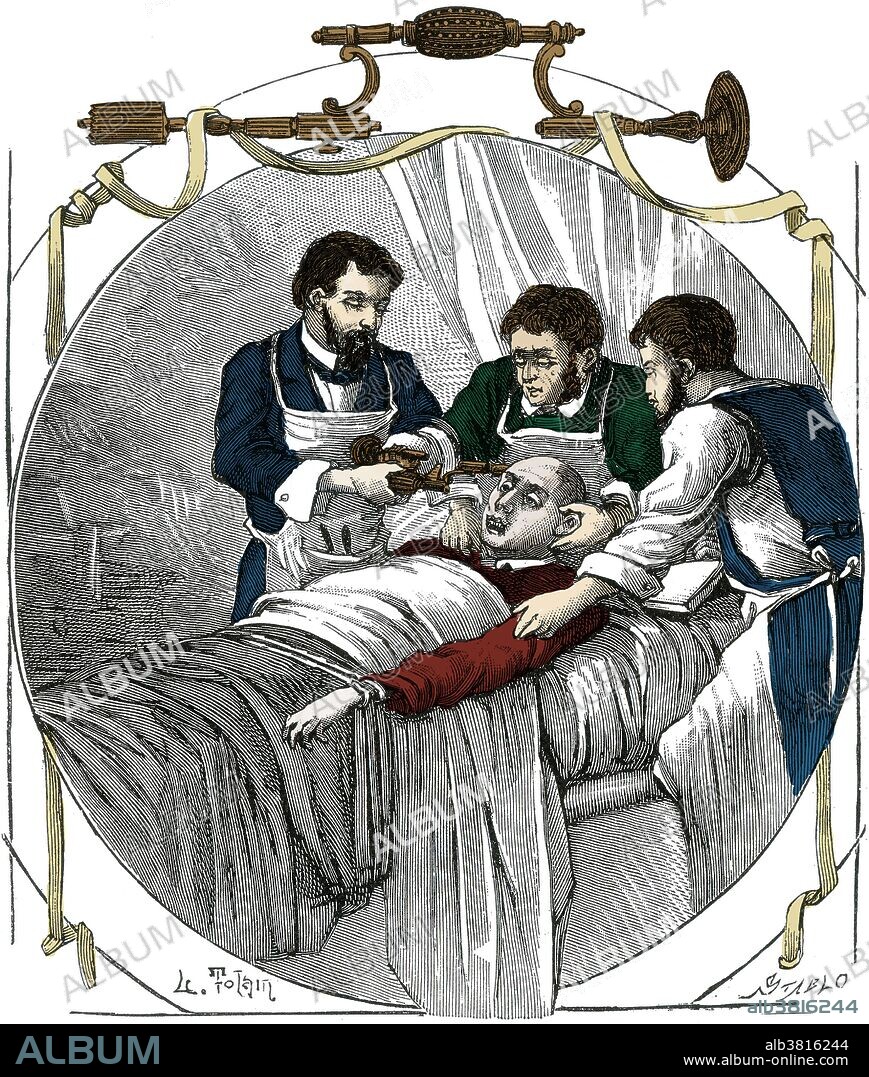 Trepanning is a surgical intervention in which a hole is drilled or scraped into the human skull, exposing the dura mater to treat health problems related to intracranial diseases. Cave paintings indicate that people believed the practice would cure epileptic seizures, migraines, mental disorders and the bone that was trepanned was kept as a charm to keep evil spirits away. Trepanation was also practiced in the classical and Renaissance periods. Hippocrates gave specific directions on the procedure from its evolution through the Greek age, and Galen also elaborates on the procedure. During the Middle Ages and the Renaissance, trepanation was practiced as a cure for various ailments, including seizures and skull fractures. No artist credited, undated. This image has been color enhanced.