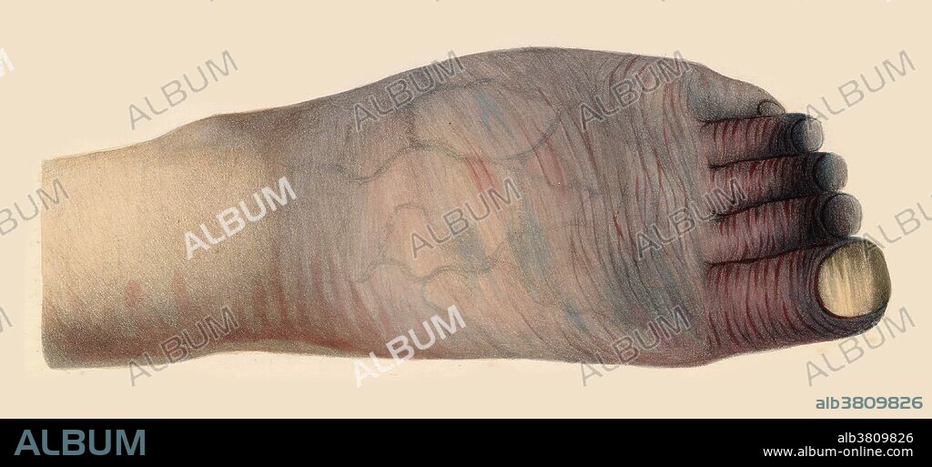Gangrene illustration from the 1830s. This foot reveals gangrena senilis, or discoloration of the toes at the beginning of the disease. Robert Carswell.