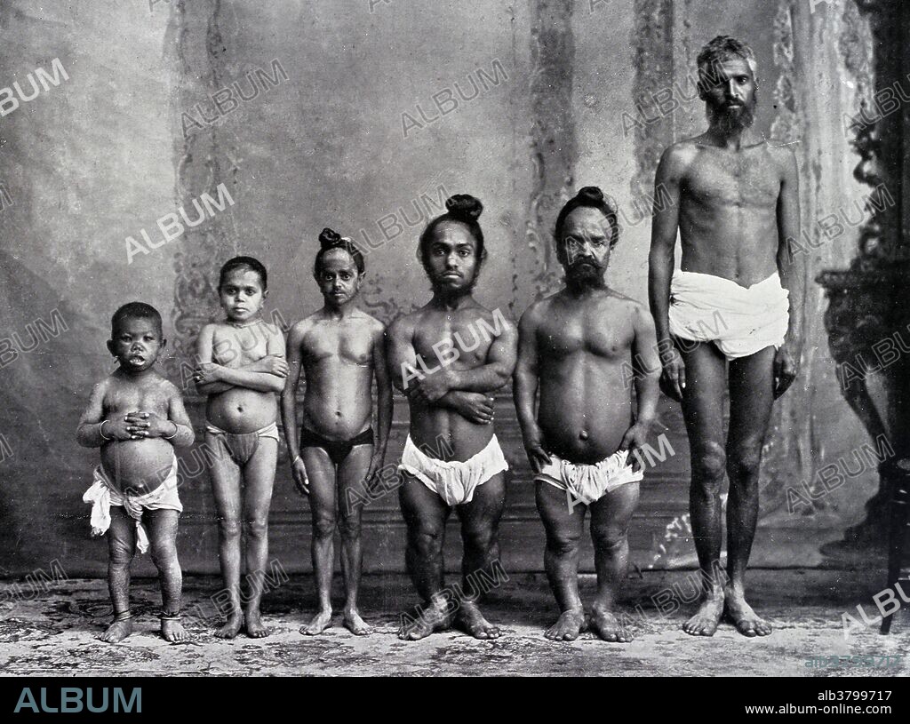 Dwarfism, 1910