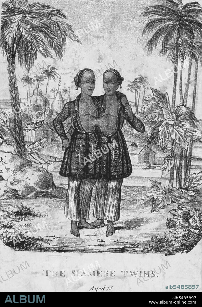 The most famous pair of conjoined twins was Chang and Eng Bunker (1811-1874), Thai brothers born in Siam, now Thailand. They traveled with P.T. Barnum's circus for many years and were billed as the Siamese Twins. Chang and Eng were joined by a band of flesh, cartilage, and their fused livers at the torso. Due to the brothers' fame and the rarity of the condition, the term came to be used as a synonym for conjoined twins. (Photo by: Wellcome Collection/Pictures From History/Universal Images Group via Getty Images).