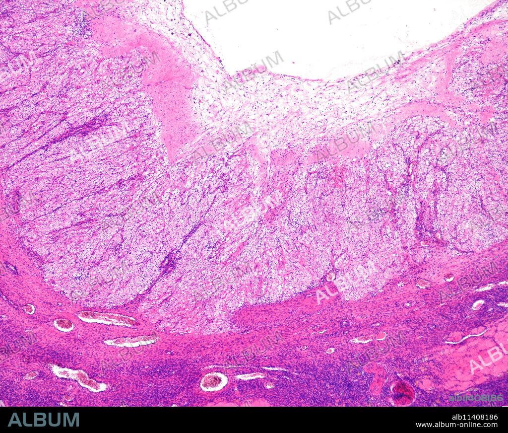 Human ovary. Regression of corpus luteum under a microscope