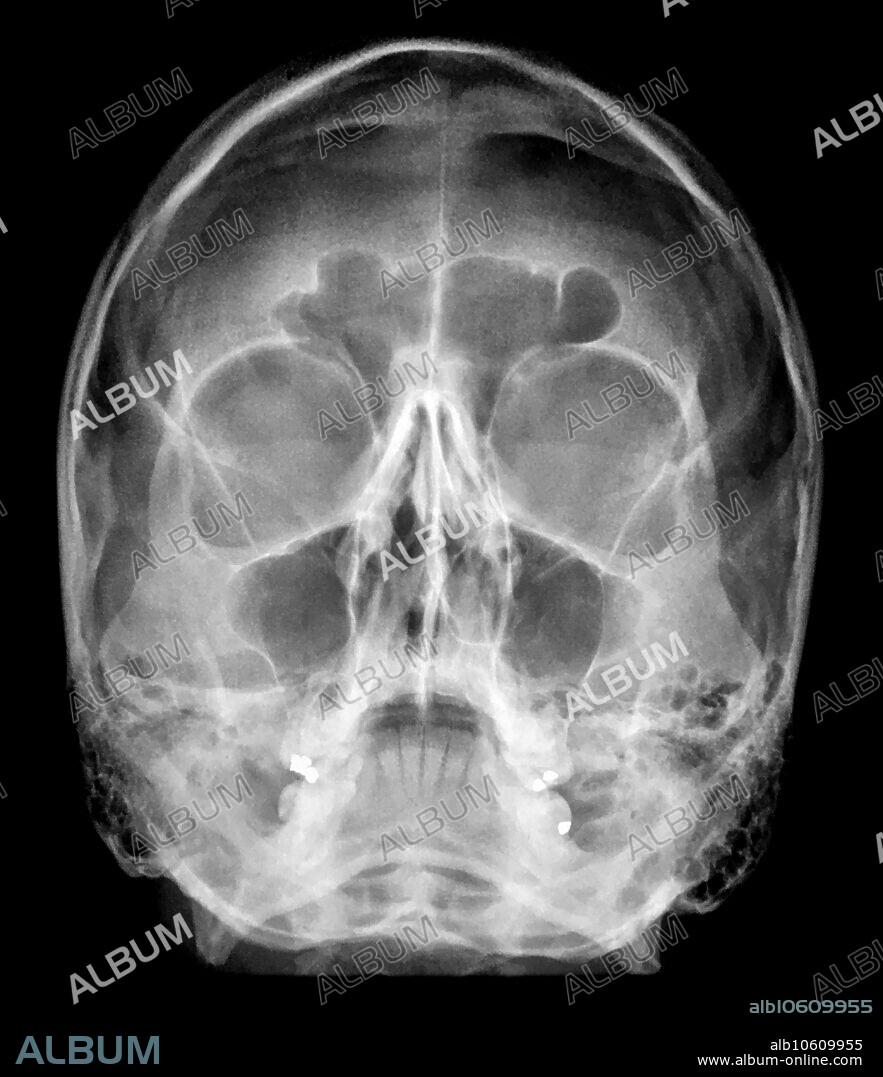This waters projection of the skull shows normal anatomy.