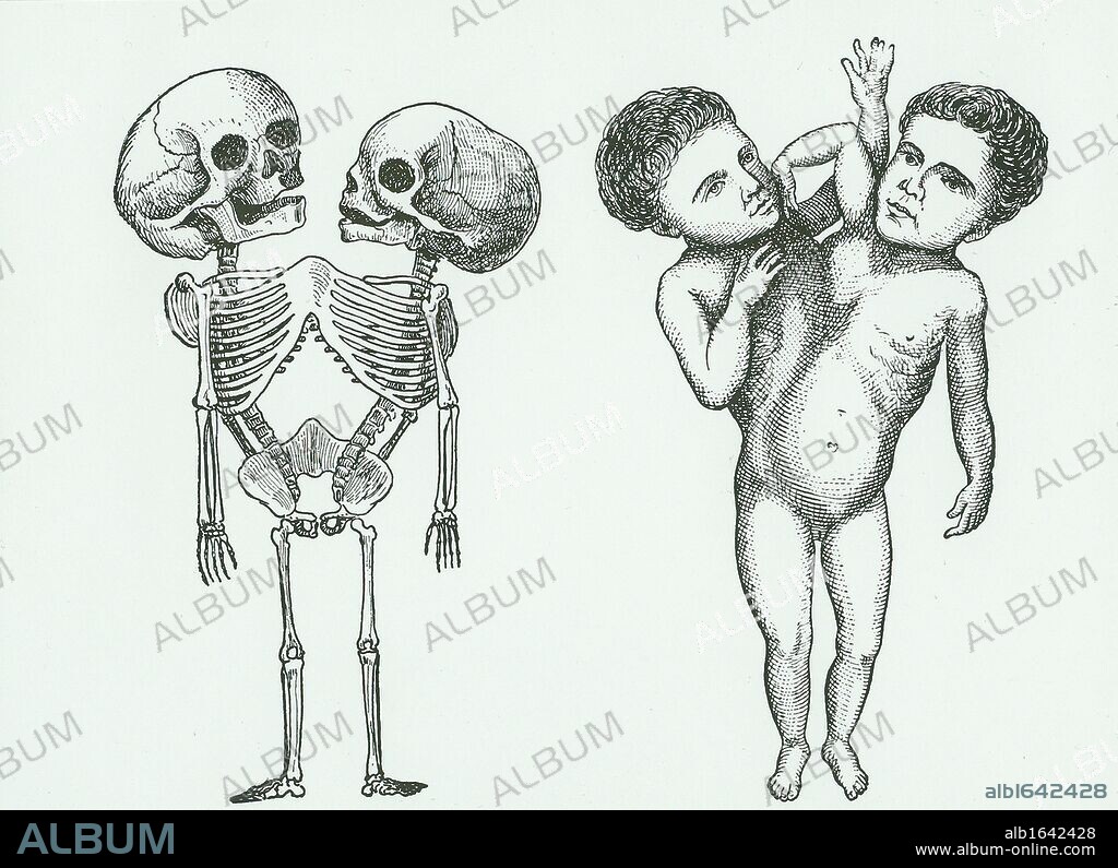 Siamese or conjoined twins. Ritta - Christina, born at Sassari, Sardinia, 23 March 1829. They were taken to Paris and exhibited and died in infancy. Engraving from "Anomalies and Curiosities of Medicine" by George M Gould and Walter L Pyle (Philadelphia, 1900).