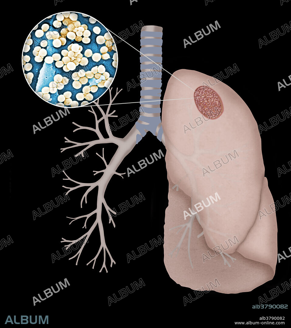 Staphylococcus infection in the lungs.