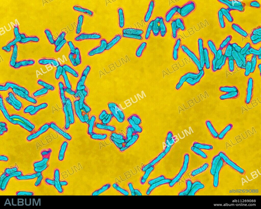 Diphtheria bacilli (Corynebacterium diphtheriae or Klebs-Loeffler bacillus). Diphtheria is a contagious infectious disease. Localization of bacilli on the larynx can cause asphyxia (croup). This bacillus produces toxins that can lead to paralysis or even death of the patient by heart attack. Optical microscopy X 1850.