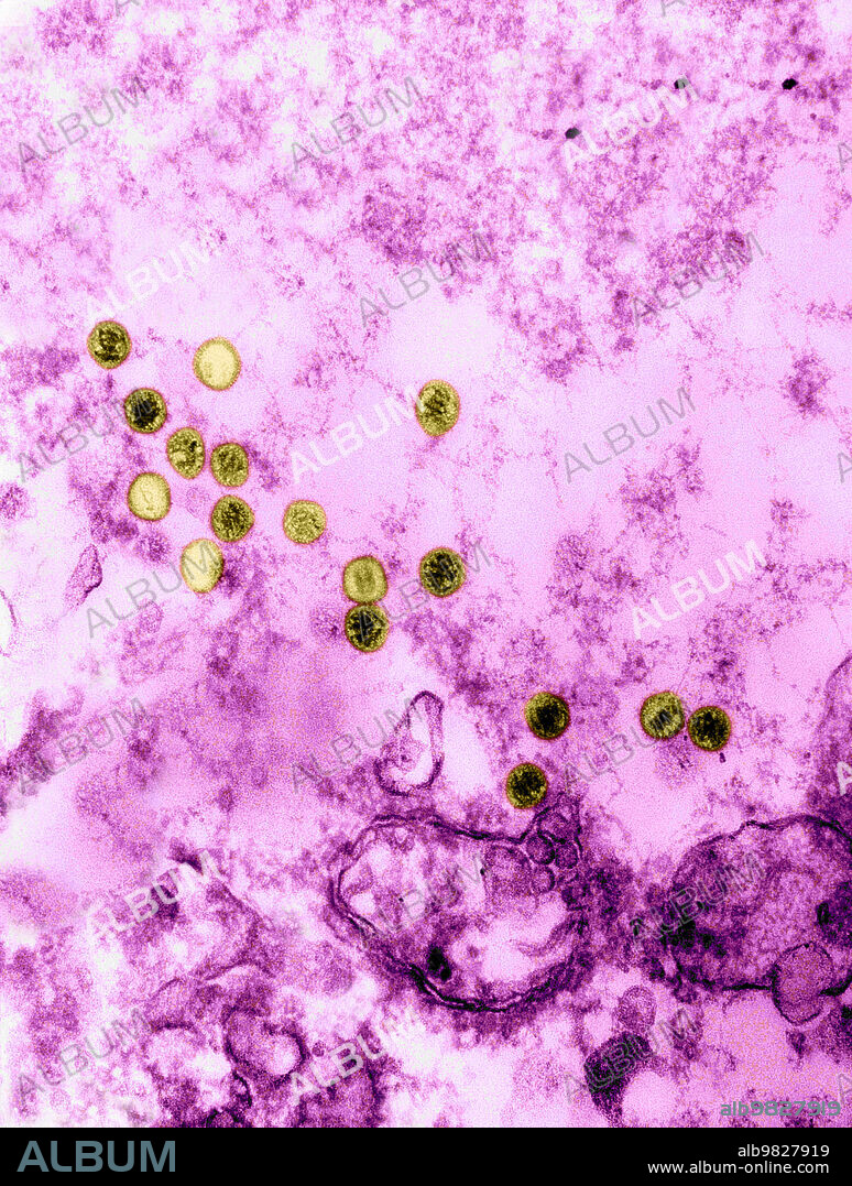 Transmission Electron Micrograph (TEM) revealing the presence of numerous Epstein-Barr virus (EBV) virions. The Epstein‚ÄìBarr virus (EBV), also called human herpesvirus 4 (HHV-4), is one of eight known human herpesvirus types in the herpes family, and is one of the most common viruses in humans.It is best known as the cause of infectious mononucleosis (glandular fever). It is also associated with particular forms of cancer, such as Hodgkin's lymphoma, Burkitt's lymphoma, gastric cancer, nasopharyngeal carcinoma, and conditions associated with human immunodeficiency virus (HIV), such as hairy leukoplakia and central nervous system lymphomas. Some 200,000 cancer cases per year are thought to be attributable to EBV. Infection with EBV occurs by the oral transfer of saliva and genital secretions. EBV is a double-stranded DNA (dsDNA) virus. Magnification: unknown.
