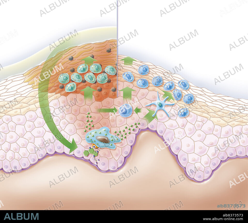 Representation of the action of a treating cream on a wart.. The ointment contains an immunomodulator that will stimulate the production of cytokines (Interferon alpha, Interleukins, TNF alpha) then triggering an immune response that will enable the treatment of the wart.. The ointment imiquimod-based does this type of action. This ointment is also efective on genital warts.