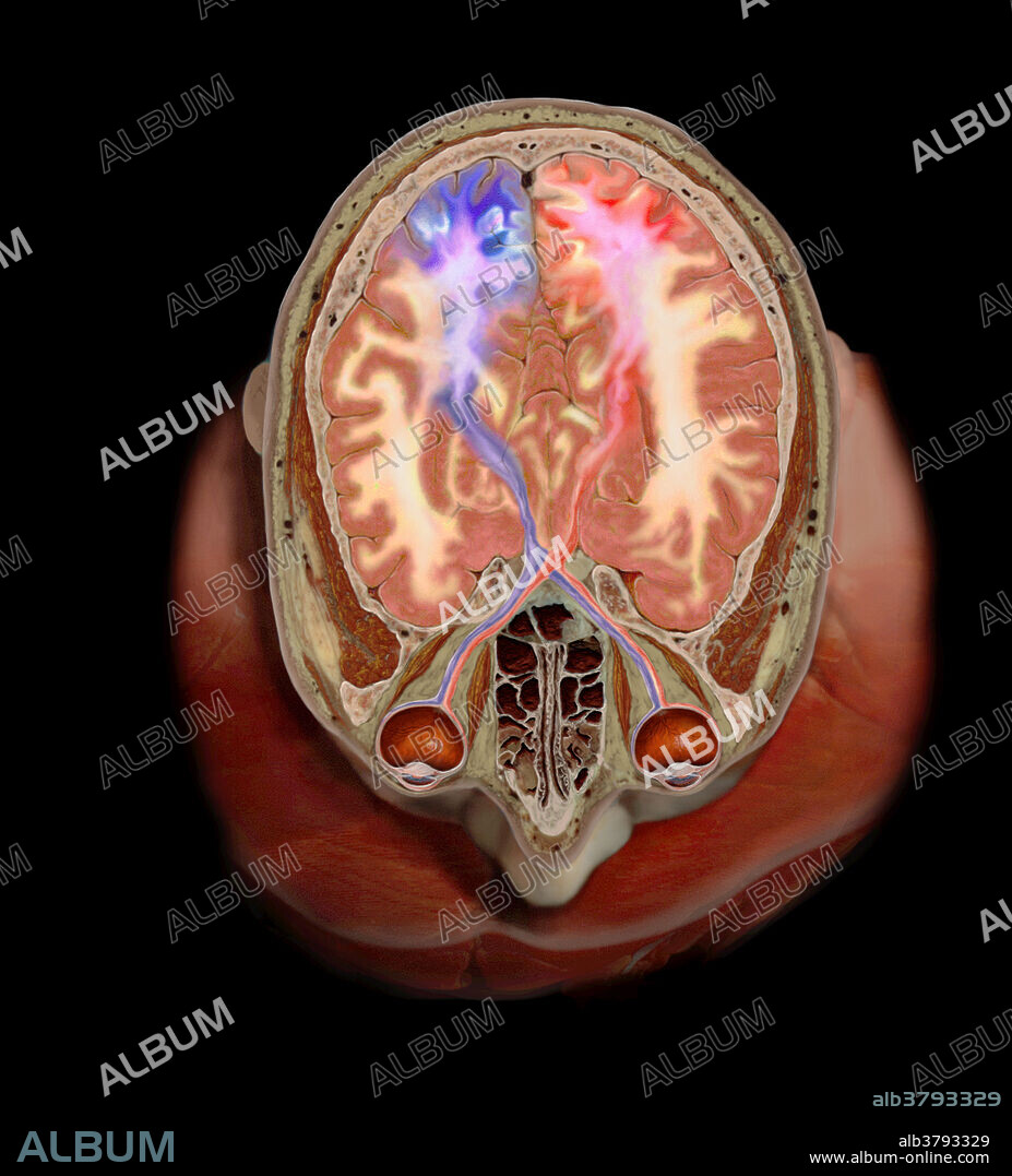 Three-dimensional visualisation of the visual pathway based on scanned human data. Electrical nerve impulses travel from the eyes to the occipital lobe in the back of the brain via millions of nerves that make up the visual pathway. The white matter of the brain is made up of millions of nerve extensions (axons) which connect nerve fibers to other nerve fibers, target tissues or organs. In this image, bundles of axons in the white matter (coloured blue and red) are seen radiating from the eyes to the visual centers of the brain.