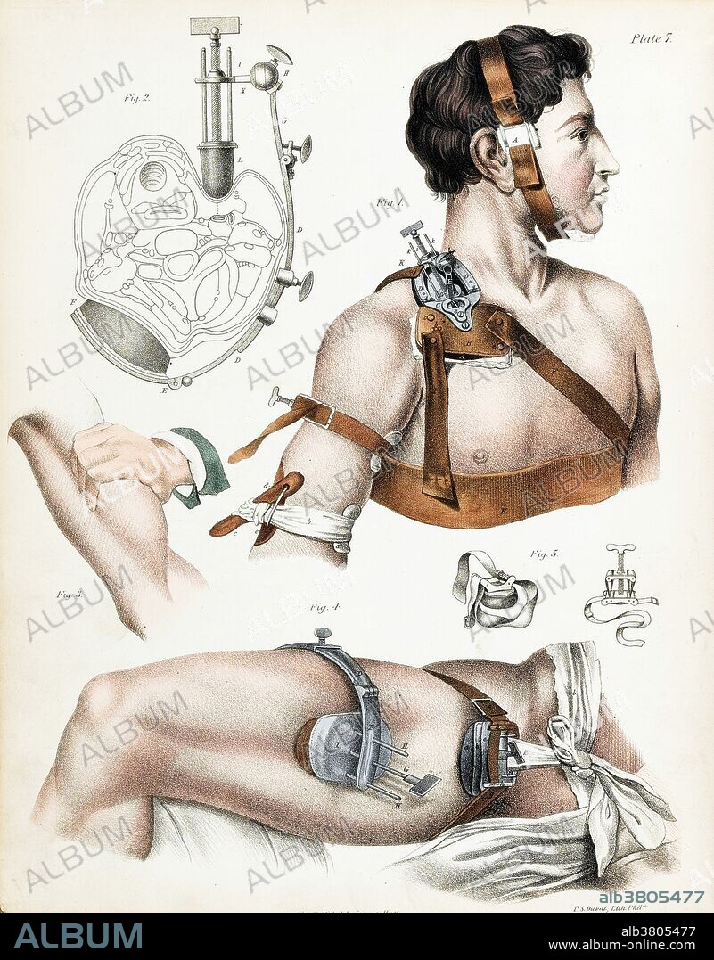 Illustration of operative surgery, 1846. From "A treatise on operative surgery comprising a description of the various processes of the art, including all the new operations; exhibiting the state of surgical science in its present advanced condition; with eighty plates, containing four hundred and eighty-six separate illustrations. Second edition, revised and enlarged." By Joseph Pancoast. Published in 1846.