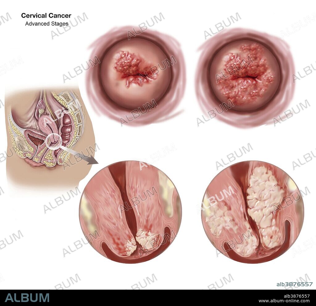 Sagittal view and vaginal view of advanced cervical cancer.