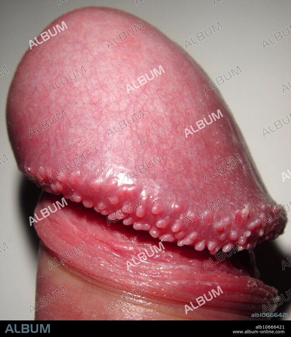 Glans (head) of the penis with hirsutoid papillomas. Hirsuties coronae glandis (PPP) are small protuberances that may form on the ridge of the glans of the human penis. They are a normal anatomical variation in humans and are sometimes described as vestigial remnants of penile spines, sensitive features found in the same location in other primates.