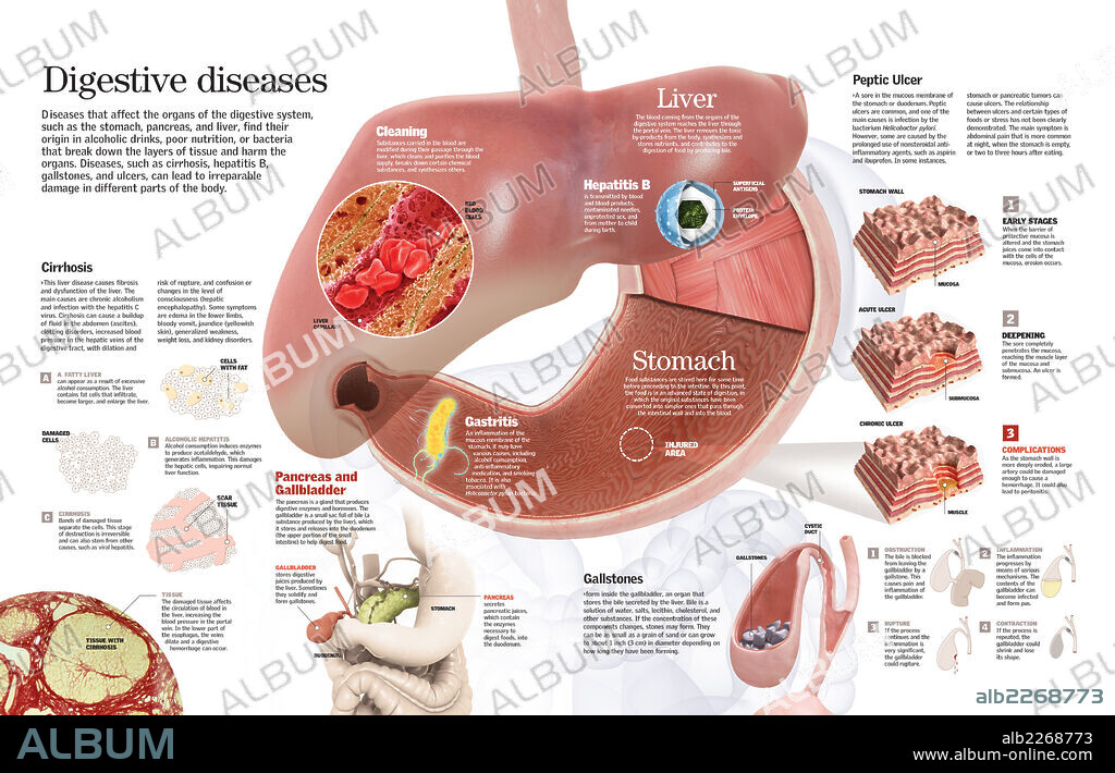 enfermedades digestivas. Infografía de las principales enfermedades que afectan a órganos del aparato digestivo, como la cirrosis, los cálculos biliares o la úlcera de estómago.