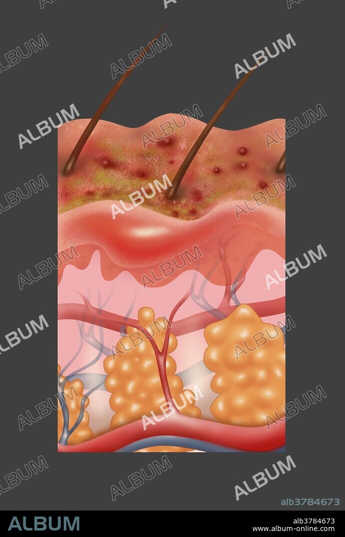 Cross-section illustration of chronic eczema on the skin. the rash becomes red and itchy. Topical steroids and ointments are used to ease the discomfort of the eczema rash.