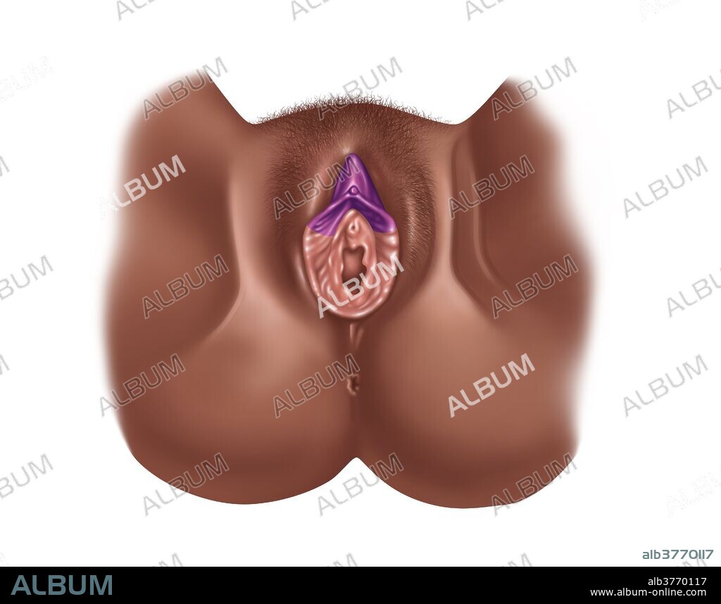 Illustration of a clitoridectomy and partial excision of the labia minora (two thirds excised). One of various methods of ritual removal of some or all of the female genitalia. These procedures are performed by a traditional circumciser using a blade or razor, with or without anesthesia. Female genital mutilation has been outlawed or restricted in most of the countries in which it occurs. It is rarely done as a therapeutic medical procedure, such as when cancer has developed in or spread to the clitoris.