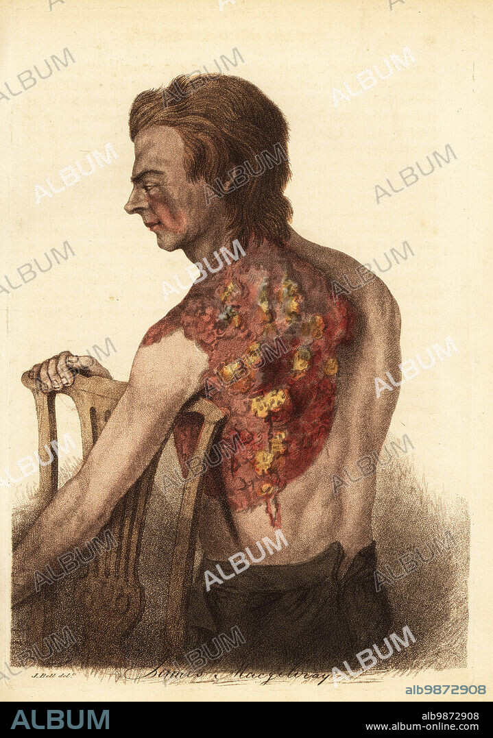 Soldier with an abscess from a gunshot wound to the shoulder. Sergeant M'Gillivray of the 68th (Durham) Regiment was shot in the shoulder in the Siege of Nijmegen, 1794. Entrance wound to the clavicle and exit at the scapula. Captured and imprisoned by the French for three years. Inflamed abscesses and ulcers cover his left shoulder and back. Cured by lancing, bathing and camomile decoction. James MacGilivray. Handcoloured copperplate engraving after an illustration by John Bell from his own Principles of Surgery, as they Relate to Wounds, Ulcers and Fistulas, Longman, Hurst, Rees, Orme and Brown, London, 1815.