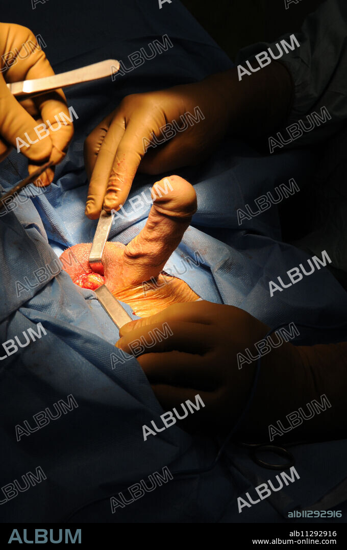 Photo essay at Lyon hospital. Department of urology. Phalloplastie, operation of plastic surgery to create a phallus, required to complete a change of sex, following a hystéro-ovariectomie.This takes place in two steps. Here step 2. Step 1: it's the creation of a neo-penis from a fragment of skin taken from the arm. The skin, the nerves, the veins and the arteries are taken from the not dominant arm to constitute the urethra, the acorn and the penis. The vaginal cavity is blocked and the big lips are used for the scrotum. The nerves which innervate the clitoris are protected, they will innervate the penis, in order to keep an orgasmic capacity after the intervention. Step 2: after the penis found its sensibility, testiculaires implants and implant are added to make an erection possible on demand.