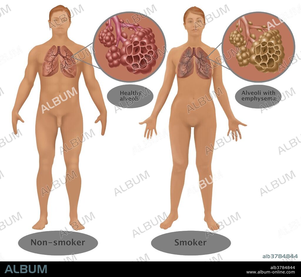 Illustration comparing the lungs and alveoli of a smoker (right) and of a non-smoker (left). Smoking can result in chronic obstructive pulmonary disease (COPD), emphysema, and cancer. Here, the smoker's lungs appear gray and the alveoli are significantly damaged (emphysema), while the non-smoker has healthy lungs and alveoli.