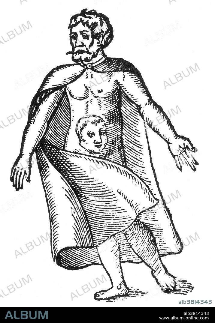 Woodcut of a "man having a head in the middle of his body" from Des Monstres et prodiges by Ambroise ParÃ©, 1573. A parasitic twin (also known as an asymmetrical or unequal conjoined twin) is the result of the processes that produce vanishing twins and conjoined twins, and may represent a continuum between the two. Parasitic twins occur when a twin embryo begins developing in utero, but the pair does not fully separate, and one embryo maintains dominant development at the expense of the other. Unlike conjoined twins, one ceases development during gestation and is vestigial to a mostly fully formed, otherwise healthy individual twin. The undeveloped twin is defined as parasitic, rather than conjoined, because it is incompletely formed or wholly dependent on the body functions of the complete fetus. The independent twin is called the autosite. Des Monstres is filled with unsubstantiated accounts of sea devils, marine sows, and monstrous animals with human faces. With its extensive discussion of reproduction and illustrations of birth defects, the book invited accusations of pornography.