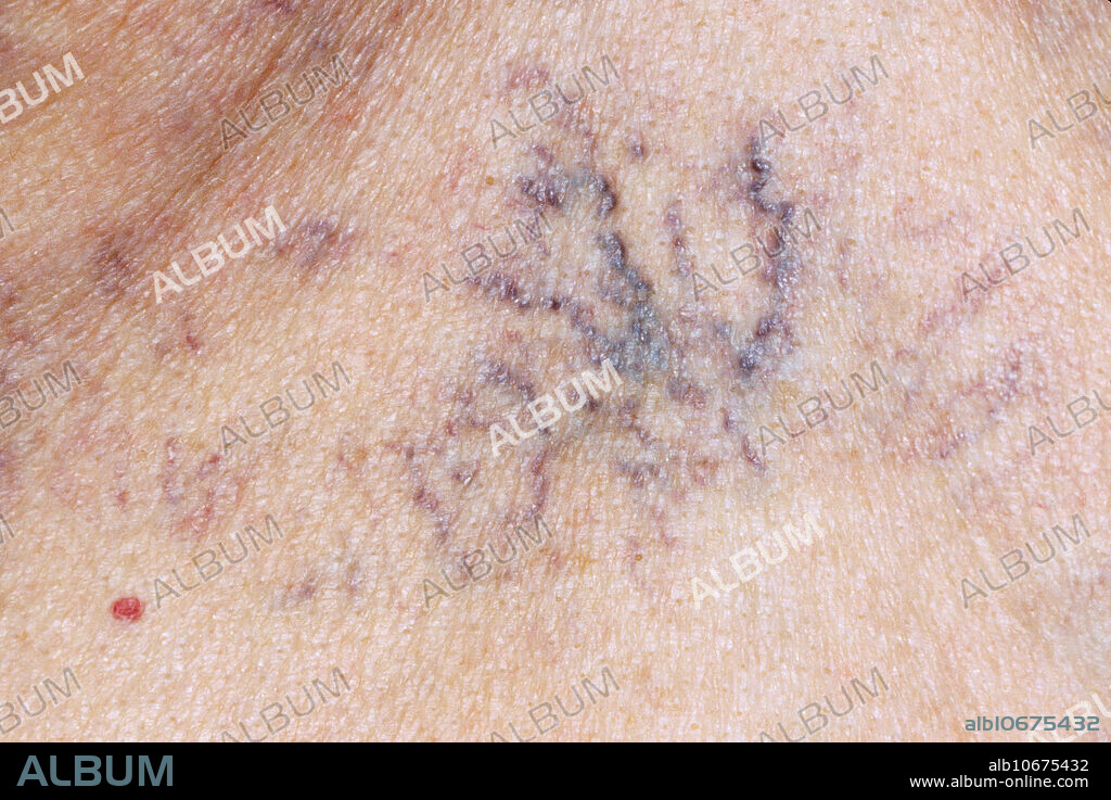Clinical photo of spider angioma, an abnormal collection of blood vessels just beneath the surface of the skin. Spider angiomas are benign and common especially during pregnancy and in liver disease.
