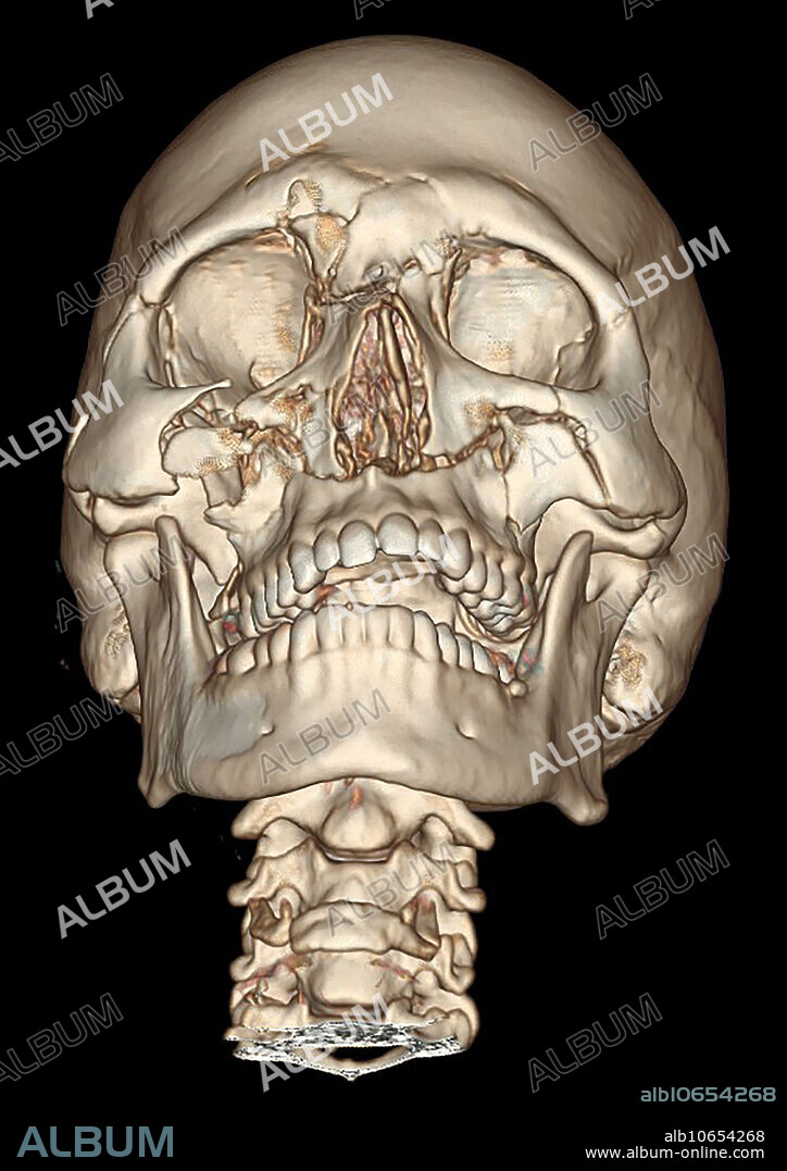 This frontal view from a 3D CT reconstruction shows extensive facial fractures representing bilateral Lefort II fractures and right sided (on viewers left) Lefort III fractures.