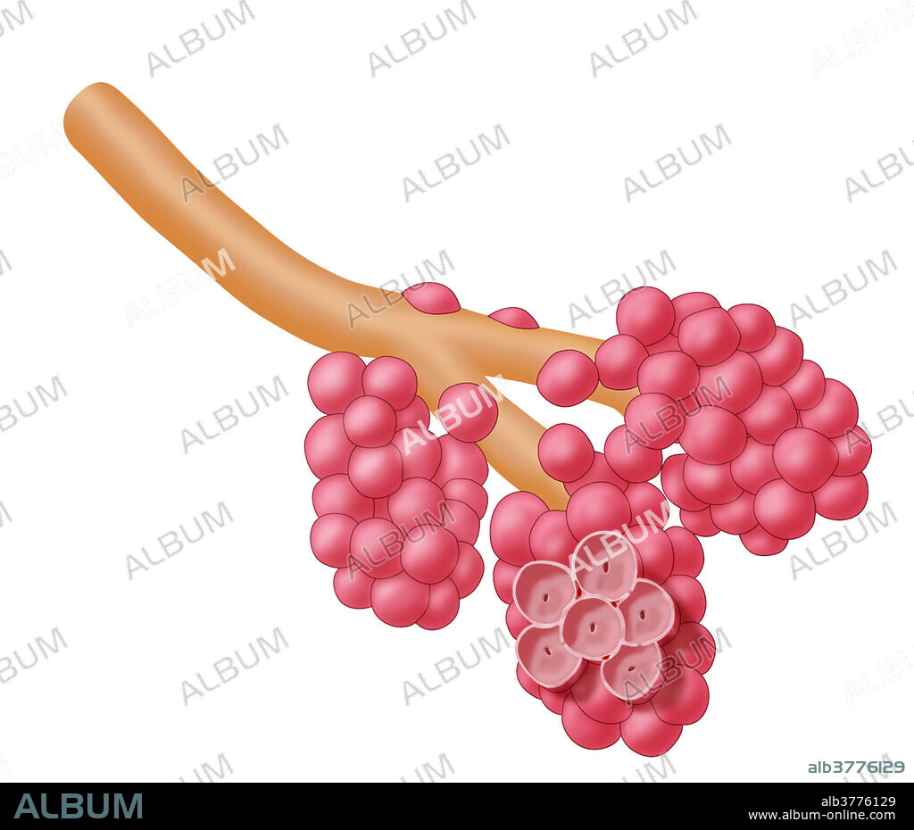 An illustration of alveoli damaged by emphysema. Emphysema is a disease often caused by cigarette smoking. It affects the lungs and the alveoli in the lungs where the exchange of oxygen and carbon dioxide occurs. The damage to the alveoli prohibits them from taking the shape necessary for inhalation and breathing.