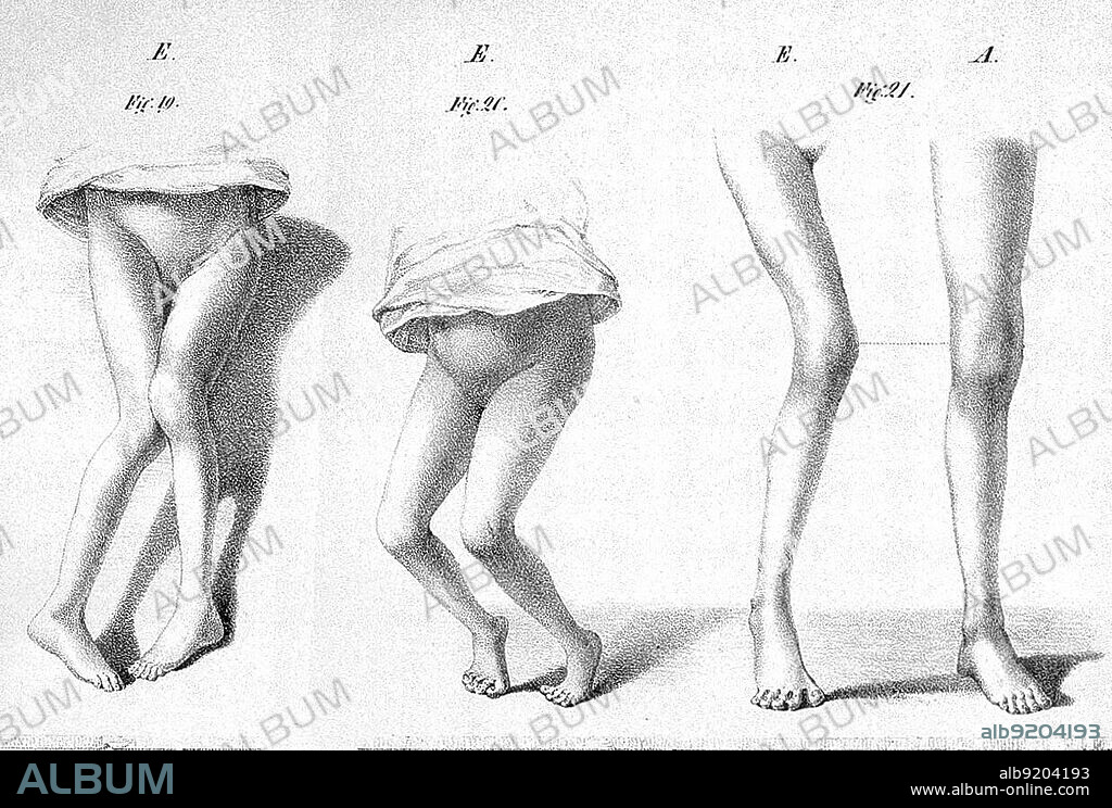 Polio Paralysis, Heine, 1840
