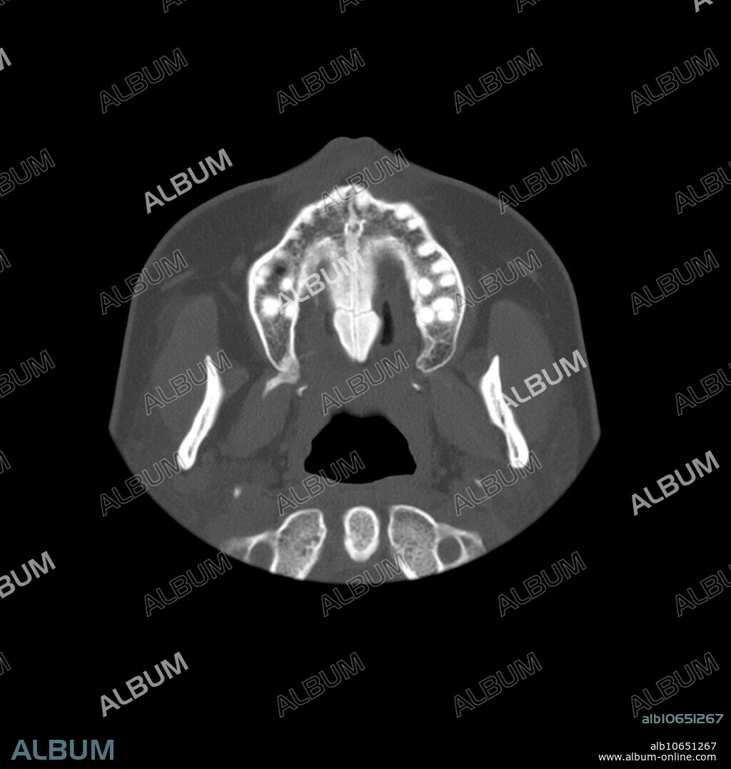This axial (cross sectional) CT image through the junction of the hard palate and the oral cavity shows the typical appearance of a bony excresence called a torus palatinus. This is a benign, bony protrusion which projects downwards from the hard palate. This is a common finding and many people are aware of this bony projection merely by running their tongue along the roof of their mouth. This is of no clinical concern.