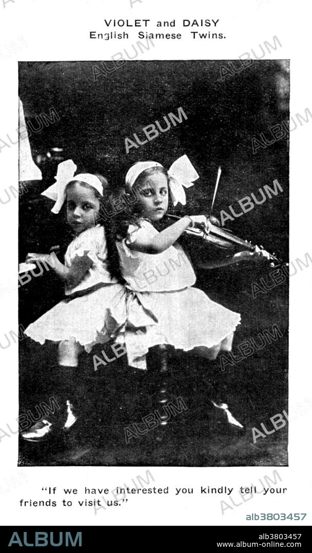 Entitled: Violet and Daisy : English Siamese twins : "if we have interested you kindly tell your friends to visit us." Daisy and Violet Hilton (February 5, 1908 - January 4. 1969) were a pair of English Siamese Twins, joined by their hips and buttocks; they shared blood circulation and were fused at the pelvis but shared no major organs. Their mother worked in a bar and sold the twins to her boss, who toured them around the world. They gained recognition in Germany, the US and Australia and tap danced in a Bob Hope act. They gained independence in 1931 and went into vaudeville. Violet was a saxophonist and Daisy a violinist. After vaudeville lost popularity, the sisters performed in burlesque, and struggled to make a living. Their last public appearance was in 1961 at a drive-in cinema in Charlotte, North Carolina. Their manager abandoned them there, and with no means of transportation or income, they were forced to take a job in a nearby grocery store. In 1969, after they failed to report to work, their boss called the police. The twins were found dead in their home, victims of the Hong Kong flu. According to a forensic investigation, Daisy died first; Violet died between two and four days later. They were 60 years old. No photographer credited, 1914.