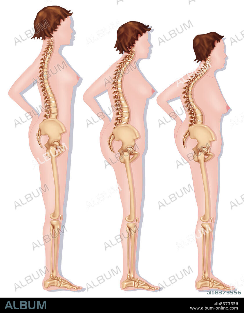 Representation of the modification of the silhouette linked to osteoporosis (vertebral compression).. On the left, silhouette of a young woman (straight stature).. In the middle, 60-year-old woman affected by medium osteoporosis. She loses a few centimeters and vaults.. On the right, 70-year-old woman affected by severe osteoporosis. The vertebral compression is very much pronounced with a tip over of the pelvis forward. We observe a dorsal kyphosis, commonly called 'witch's hump'.. The vertebral compression is due to fractures of various vertebrae (generally dorsal and lombar), fragilised by osteoporosis.. See images 1926407 and 1926807 for the evolution of the vertebral compression, 1926507 and 1926907 for the young woman, 1926607 and 1927007 for medium osteoporosis, 1926707 and 1927107 for severe osteoporosis.