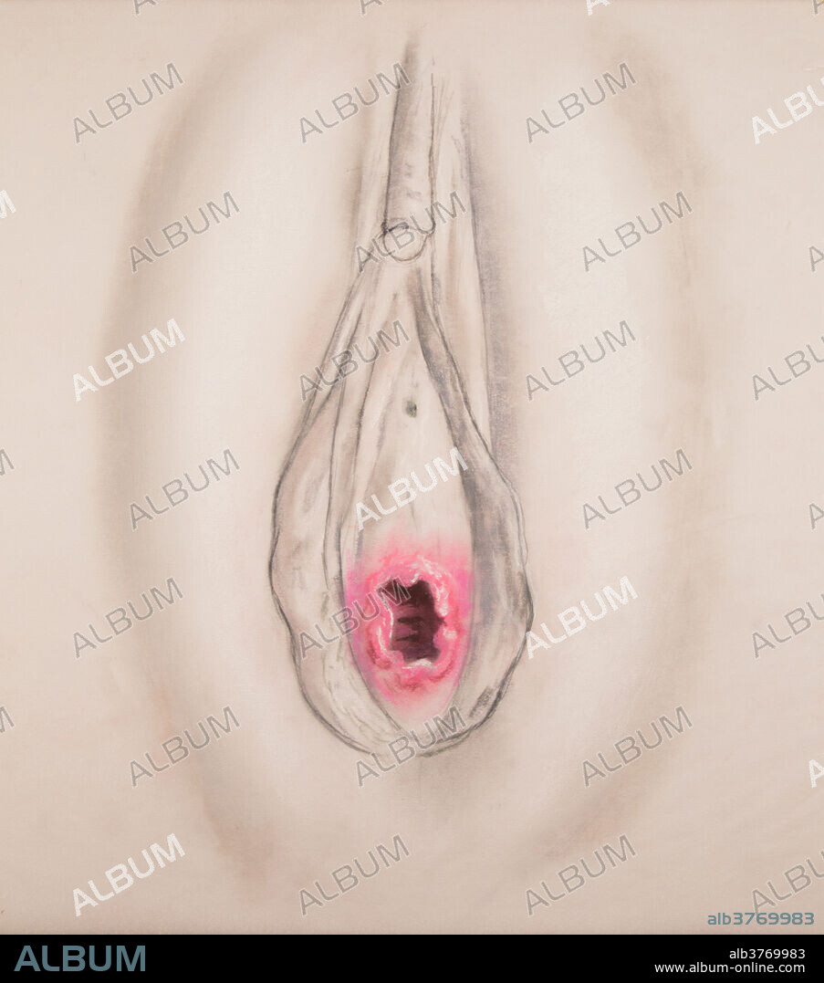 The hymen is a membrane that partly covers the opening of the vagina. It's strength, elasticity, form and appearance can vary greatly from one individual to another. In most cases it's presence or condition is not a reliable indicator of virginity. Physical exercise, tampon use, medical exams, masturbation, and injuries can all rupture the hymen besides sexual intercourse. In some cases the hymen may be elastic enough to allow sexual intercourse without altering it's appearance. Thus the tradition in many cultures that a bride must bleed on her wedding night to prove her virginity is completely unfounded.