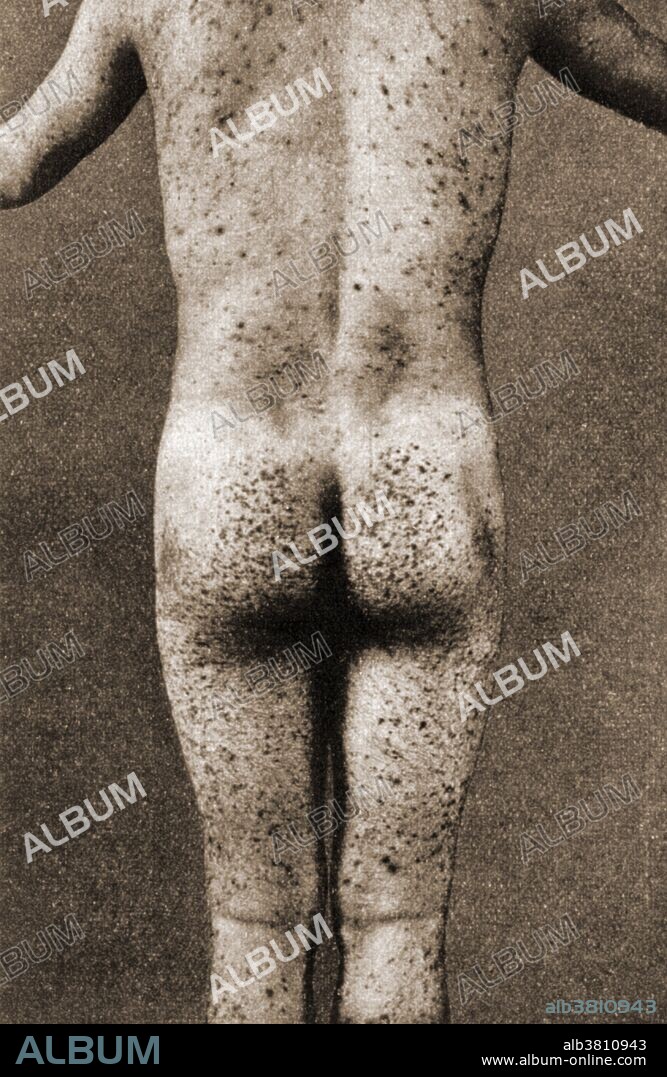 Scurvy. Male figure showing skin eruptions, back view. Scurvy is a disease resulting from a lack of vitamin C. Early symptoms include weakness, feeling tired, curly hair, and sore arms and legs. Without treatment, decreased red blood cells, gum disease, and bleeding from the skin may occur. As scurvy worsens there can be poor wound healing, personality changes, and finally death from infection or bleeding.