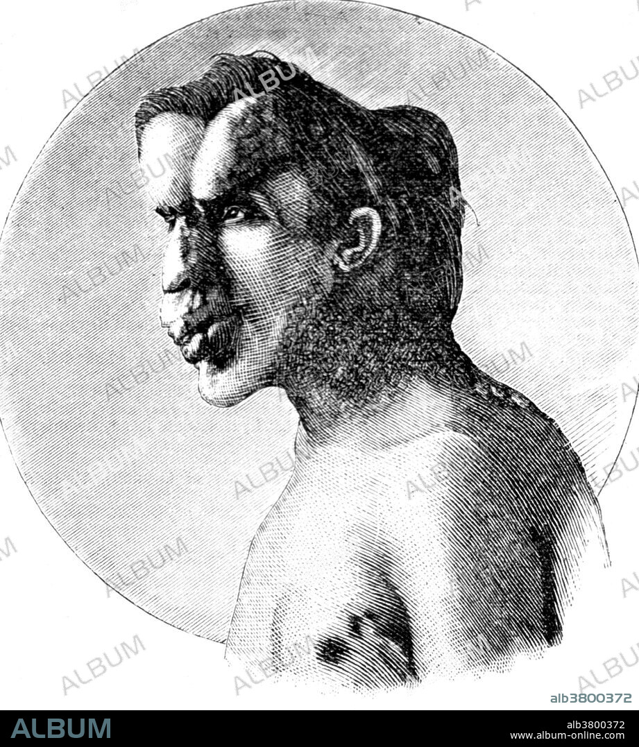 Joseph Carey Merrick (1862-1890) was an English man with severe deformities who was exhibited as a human curiosity named the Elephant Man. He became well known in London society after he went to live at the London Hospital. Although his condition was incurable, Merrick was allowed to stay at the hospital for the remainder of his life. English surgeon Frederick Treves visited him daily and the pair developed quite a close friendship. Merrick was originally thought to be suffering from elephantiasis. He died in 1890, aged 27. The official cause of death was asphyxia, although Treves, who dissected the body, said that Merrick had died of a dislocated neck. The exact cause of Merrick's deformities is unclear. The dominant theory was that Merrick suffered from neurofibromatosis type I. In 1986, a new theory emerged that he had Proteus syndrome. In 2001 it was proposed that Merrick had suffered from a combination of neurofibromatosis type I and Proteus syndrome. DNA tests conducted on his hair and bones have proven inconclusive.