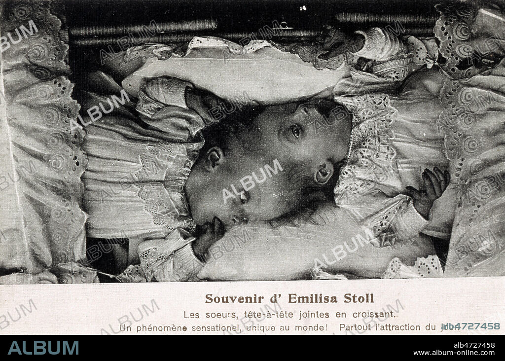 Soeurs siamoises montrees dans les foires ou les cirques au debut du siecle: 'Souvenir d'Emilisa Stoll, les soeurs, tet-a-tete e croisant, un phenomene sensationel, unique au monde! Partout l'attraction du jour.' Carte postale vers 1905. Credit: Cheuva / KHARBINE-TAPABOR.