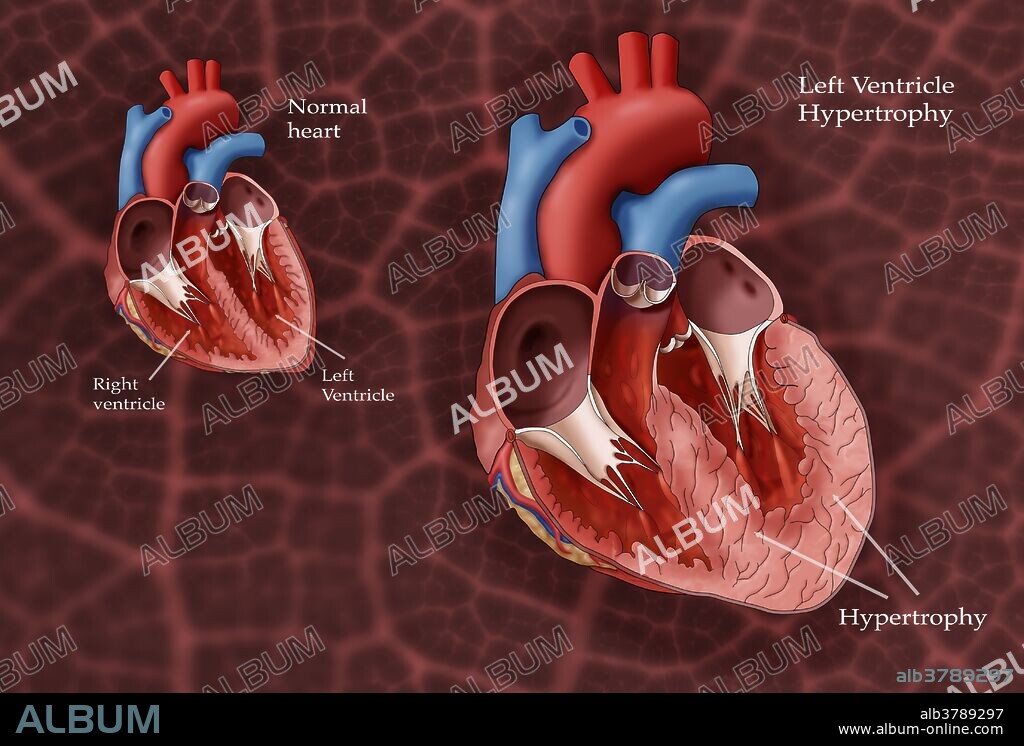 Illustration showing a normal heart at left and a heart with left ventricle hypertrophy at right. Left ventricle hypertrophy (LHV) can develop in response to factors such as high blood pressure which require the left ventricle to work harder. As the workload increases, the walls of the chamber grow thicker, lose elasticity and eventually may fail to pump as efficiently as a healthy heart.