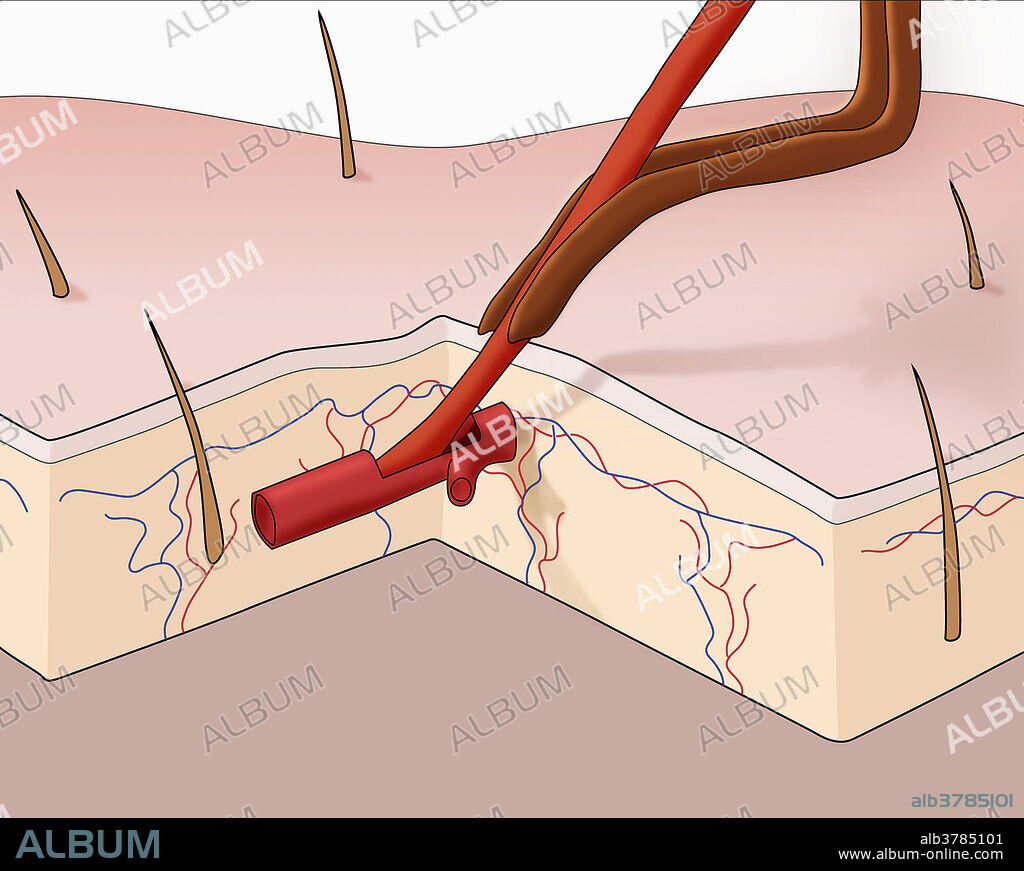 Illustration showing a mosquito's proboscis protruding through the skin.
