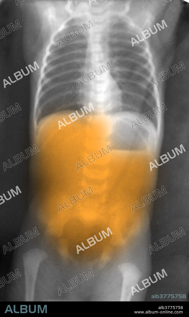 X-ray of a 7 day-old child's abdomen who has been suffering from pyloric stenosis; the narrowing (stenosis) of the opening from the stomach to the first part of the small intestine due to enlargement of the pylorus, the muscle surrounding the opening. This causes projectile vomiting and weight loss. The x-ray shows air in stomach but no air more distally beyond stomach.