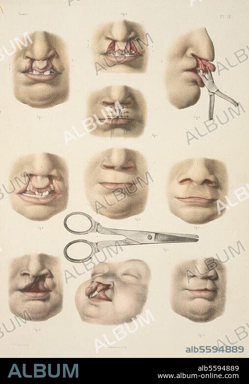 Medizin / Hasenscharte - Labium fissum. "Becs-de-lièvre". (Operationen der Hasenscharte. Farblithographie nach Zeichnung von Nicolas Henri Jacob (1782-1871). Aus: M.J. Bourgery, Traité complet de l'anatomie de l'homme, 1831-54, Bd. 7, Tf. 18. Privatsammlung.