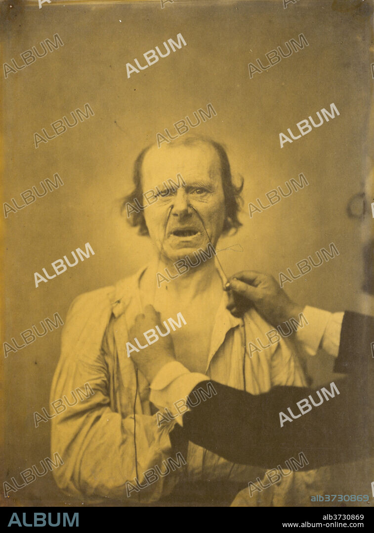 GUILLAUME-BENJAMIN-AMANT DUCHENNE (DE BOULOGNE). Discontent, bad humor, plate 52 from the album, The Mechanism of Human Facial Expression. Dated: 1854-1856. Dimensions: image: 22.7 × 16.7 cm (8 15/16 × 6 9/16 in.)  mount: 43 × 27.9 cm (16 15/16 × 11 in.). Medium: albumen print, printed 1862.