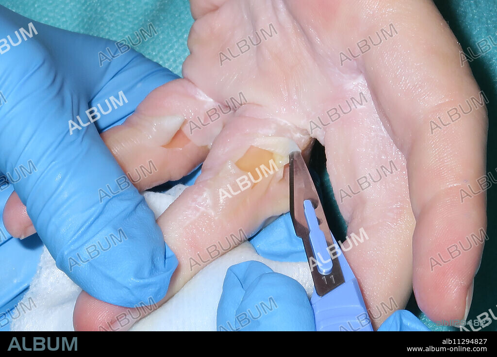 Excision of blisters from a second-degree burn by boiling water of the hand in a 21-year-old woman.