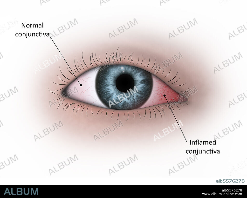 Medical illustration of conjunctivitis in the human eye.