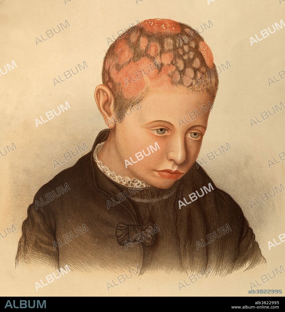 Kerion from ringworm (Tinea tonsurans et Kerion confertum). A kerion is an abscess caused by fungal infection. It most often occurs on the scalp (tinea capitis). This image shows a young male infected by a fungus referred to as ringworm. It has caused scalp lesions called Kerion and hair loss at the site of the ulcers. The lesions are typically spongy with a deep centre and crusty raised outer edges. The fungus (tinea corporis) is easily spread among humans but is not harmful and can be easily treated with anti-fungal medication. Chromolithograph, 1878-1888. Illustration by E. Burgess after R. W. Sherwin, Mabel Green and Jonathan Hutchinson.