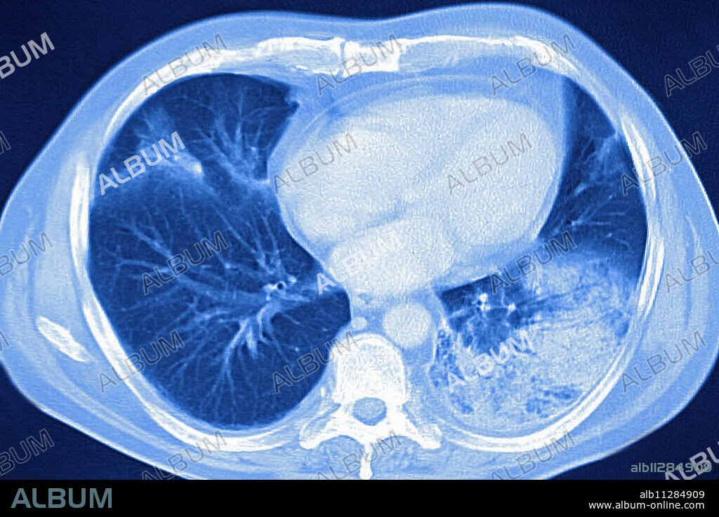 Acute pneumonia, seen on a cross-section thoracic CT-scan.